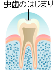 虫歯の進行　CO（シー・ゼロ）　エナメル質齲蝕