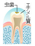 虫歯の進行　C1　エナメル質齲蝕