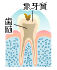 虫歯の進行　C2　象牙質齲蝕