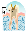 虫歯の進行　C3　歯髄齲蝕